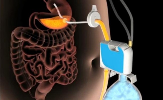 Pump, gadget that pulls food out of the stomach 