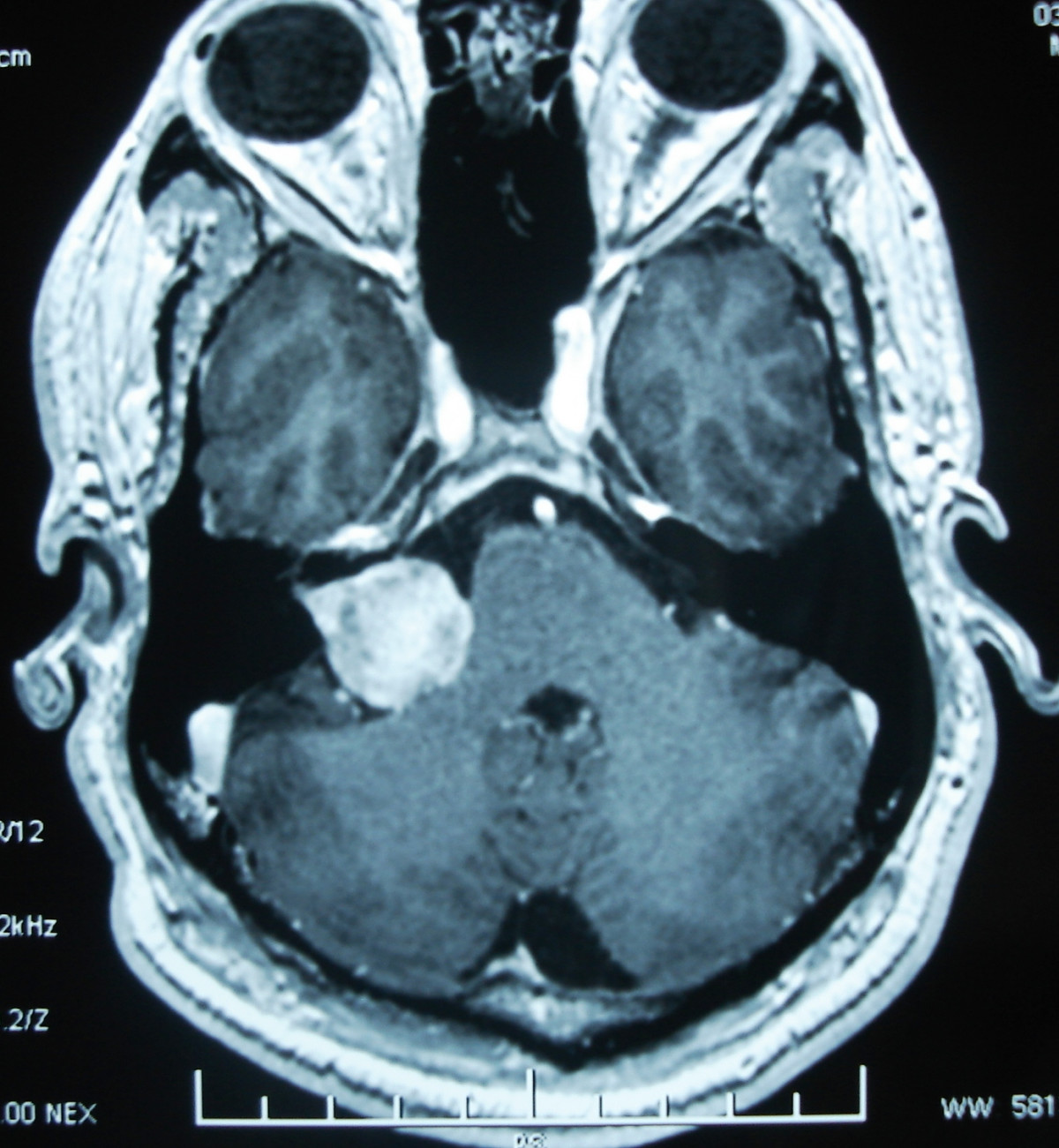 Magnetic Resonance (MR) image of vestibular schwannoma. Jaiswal et al. Journal of Negative Results in BioMedicine 2009